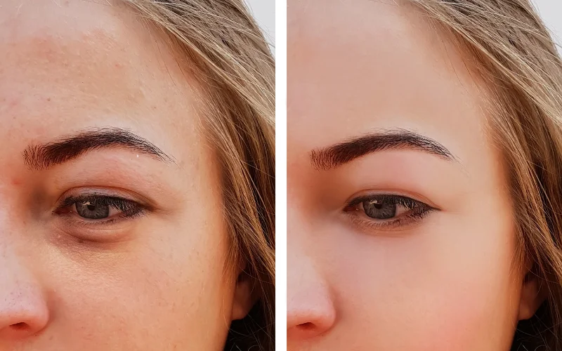 How To Get Rid of Eye Bags Quickly?