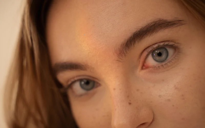 How To Get Rid of Freckles? 14 Effective Methods