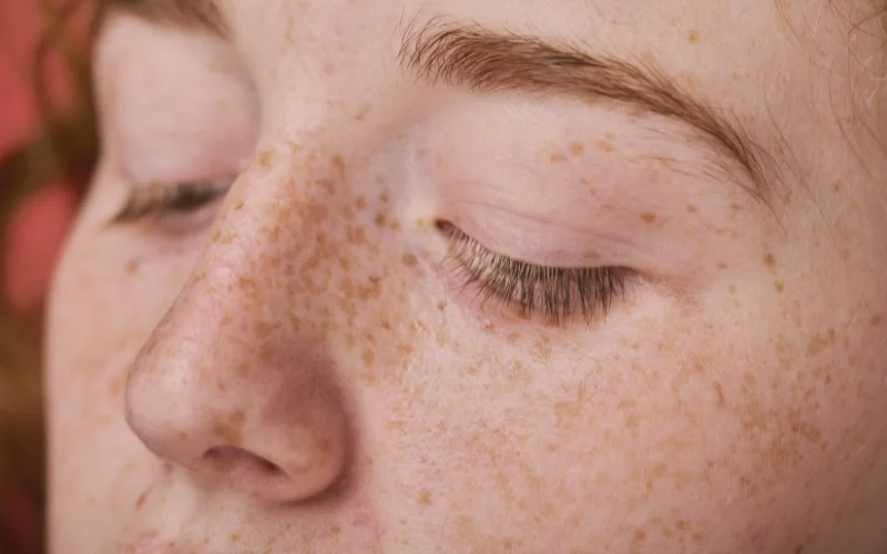 The Truth About Retinol's Impact on Freckles