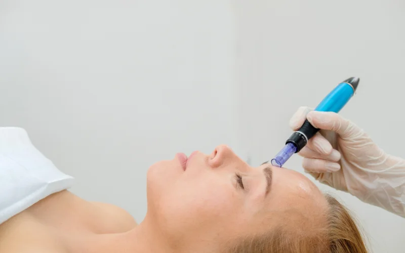 What is Microneedling?