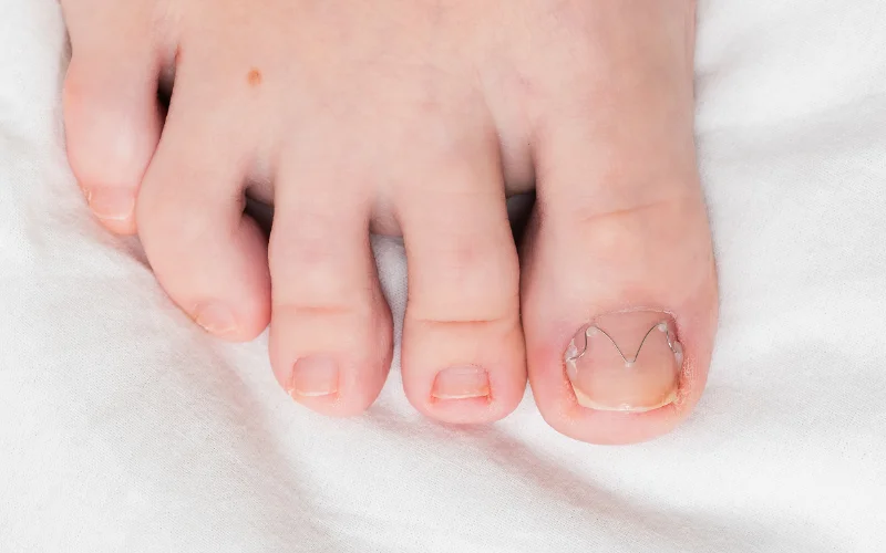 What is Toenail Fungus?